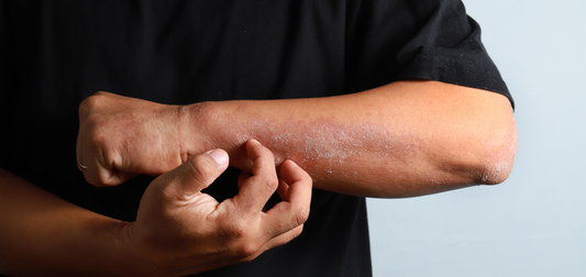 Person scratching dry, flaky, inflamed skin on their forearm, showing visible signs of eczema