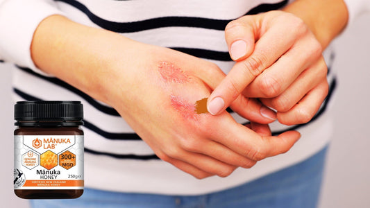 Manuka Honey for scars and wounds graphic